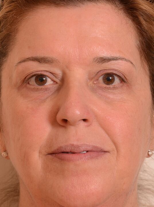 Aš atjaunėjau veidą su eudalie kremu