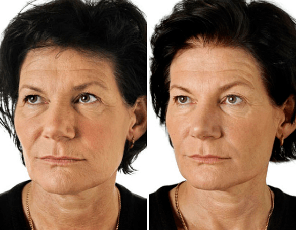 Frakcinio veido atjauninimo rezultatas