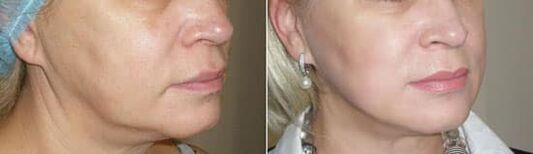 Nuotrauka, pritaikius procedūrą